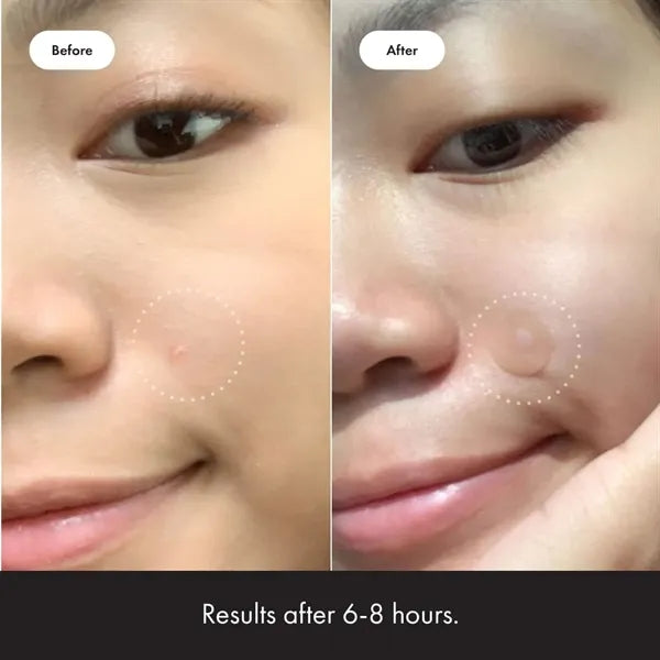 Invisible Acne Patch - Fast & Gentle Treatment