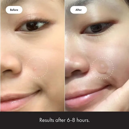Invisible Acne Patch - Fast & Gentle Treatment